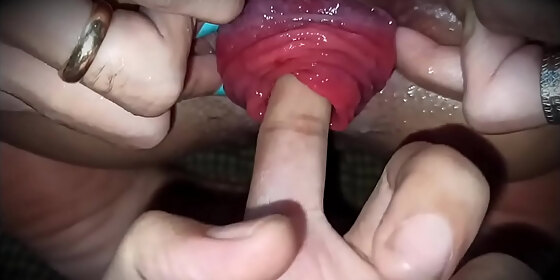prolapse finger